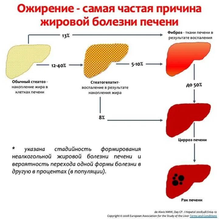 Ожирение печени фото у женщин Картинки УДАЛИТЬ БОЛЬ В ПЕЧЕНИ