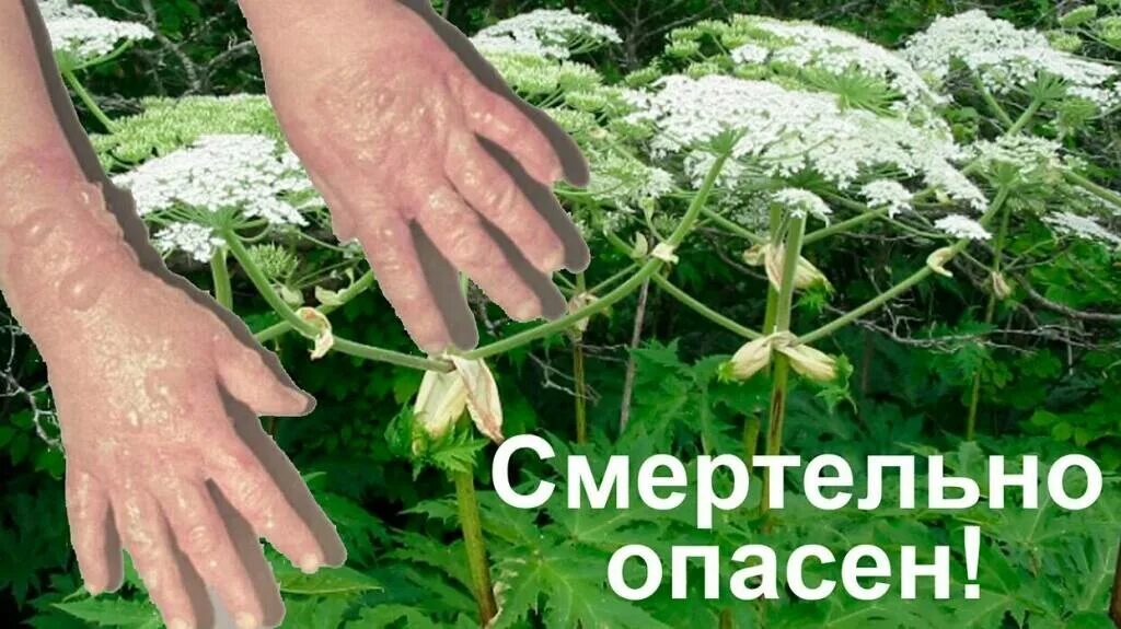 Ожог борщевиком фото по стадиям развития Нацистский борщевик вырубать надо под корень (Халида Шариф) / Стихи.ру