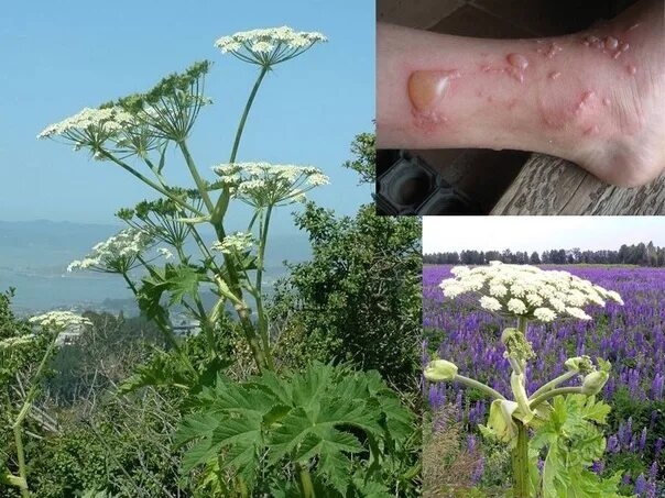 Ожог борщевиком фото по стадиям развития ATTENTION: BORING ☢ ☘ All parts of this poisonous plant are dangerous. Stems, le