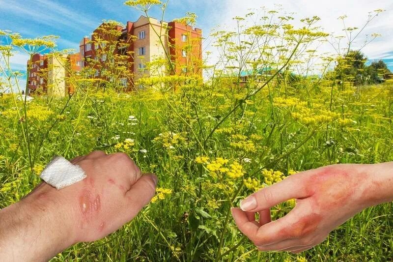 Ожог борщевиком фото по стадиям развития Ожоги борщевиком