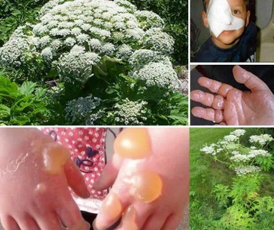 Ожог борщевиком фото по стадиям развития Hogweed Plant: If You See This Plant, Don’t Touch It Hogweed plant, Plants, Pois