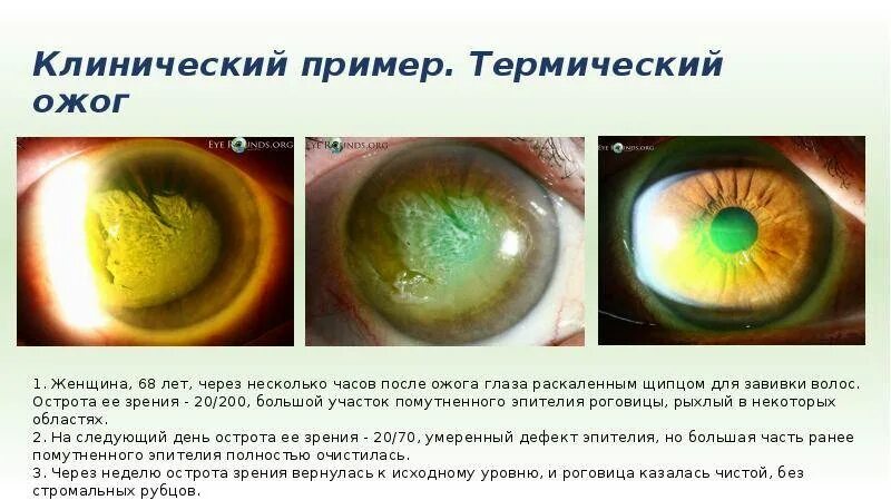 Ожог глаз фото Попадание аммиака на кожу: найдено 85 картинок