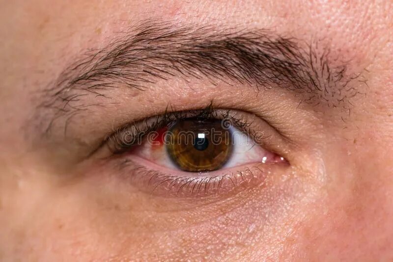 Ожог глаз фото Eye Injury, Young Man with Burst Blood Vessel in Eye, Fatigue, Problems with Blo