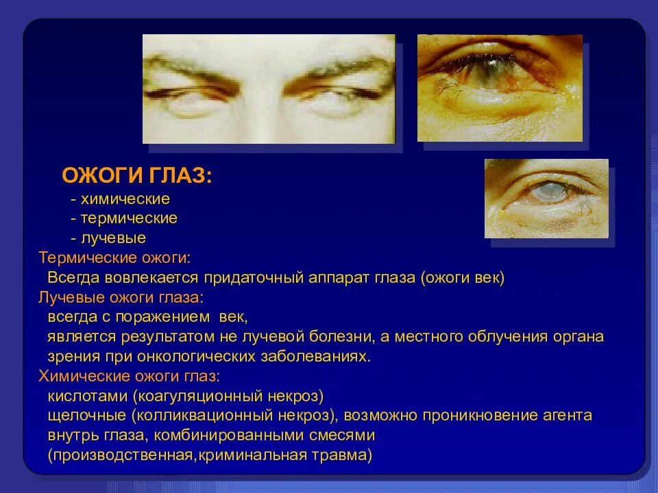 Ожог глаз фото Первая помощь при ожоге глаз химическими веществами