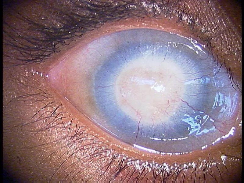 Ожог глаз фото Corneal opacity - Cancer Therapy Advisor