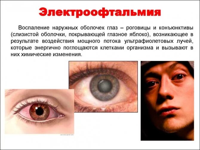 Ожог глаз фото Кератит: симптомы, лечение, причины и виды кератита глаза у взрослых