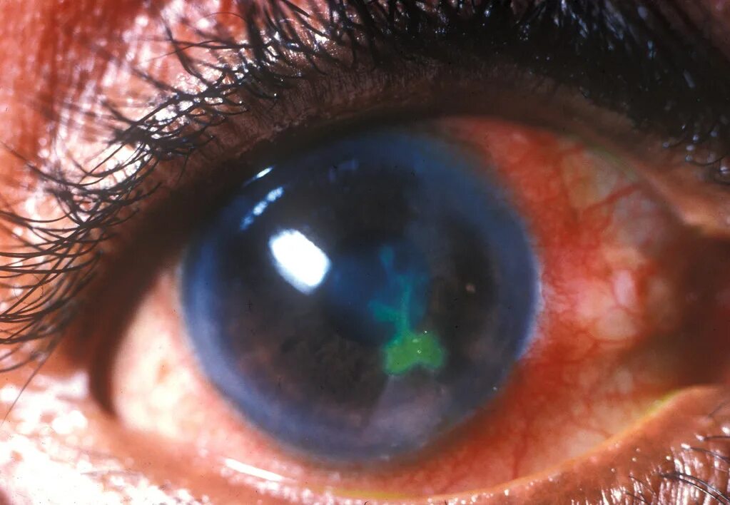 Ожог глаз фото Corneal ulcer - dendritic ulcer, fluorescein staining. Flickr
