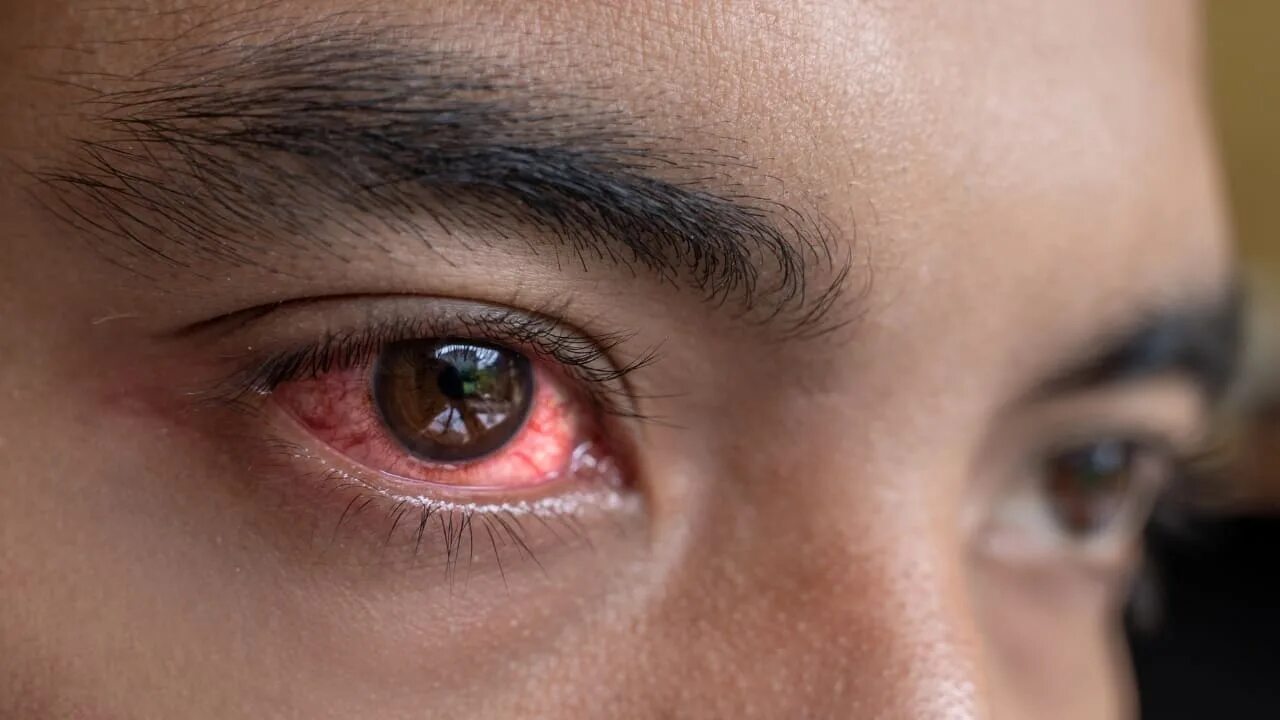 Ожог глаз фото Conjunctivitis symptoms, and 10 most effective tips to manage pink eye in rainy 