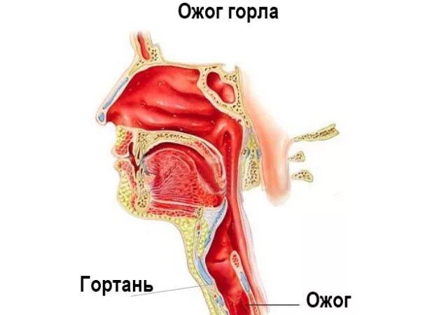 Ожог горла фото Ребенок обжог горло