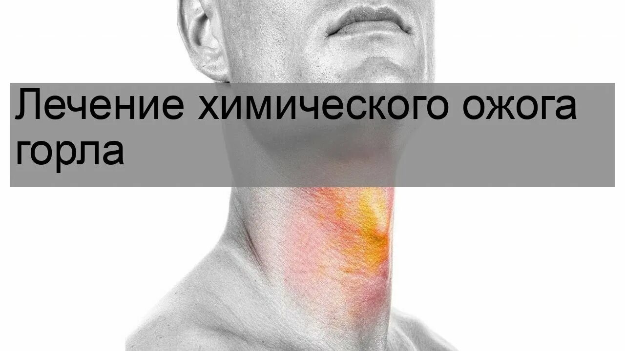 Ожог горла фото Лечение химического ожога горла - YouTube