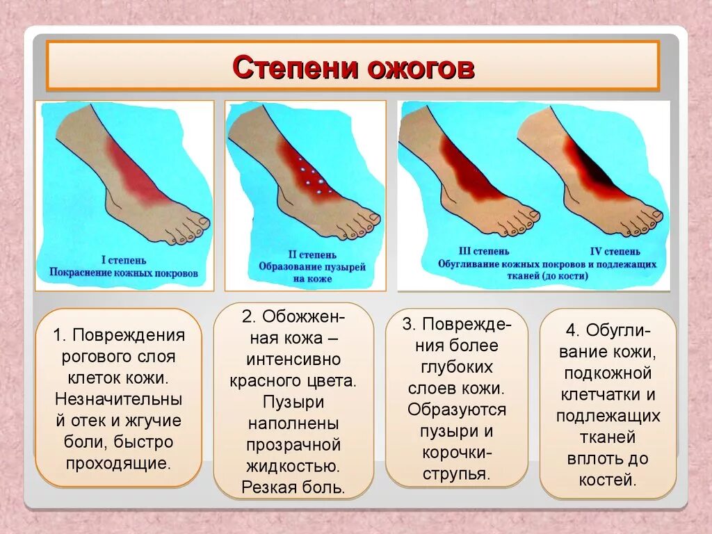 Ожог горячей водой фото ОБЖ Ожоги - смотреть видео онлайн от "Приказано выжить - канал учителя ОБЖ" в хо
