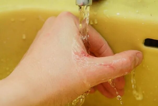 Ожог горячей водой фото Куда бежать и что делать, если ребёнок ошпарил руку? - СМИ2