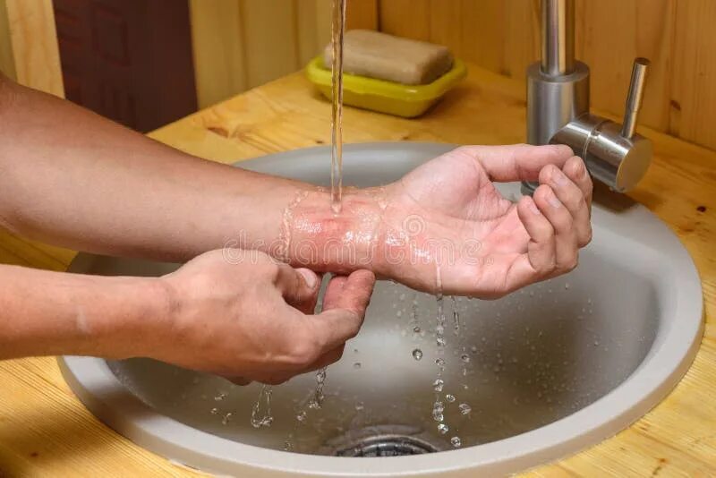 Ожог горячей водой фото A Man Washes an Abrasion on His Arm Under Running Water Stock Photo - Image of r