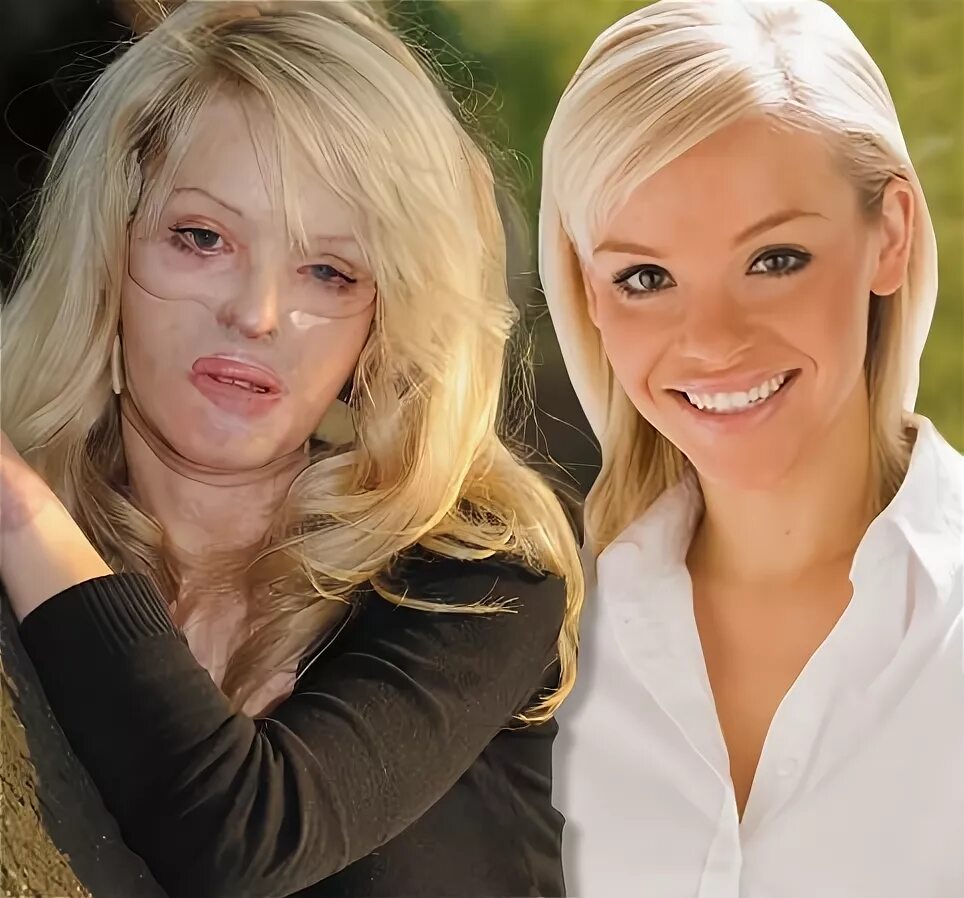 Ожог лица фото Katie Piper - Son Dakika Haberler