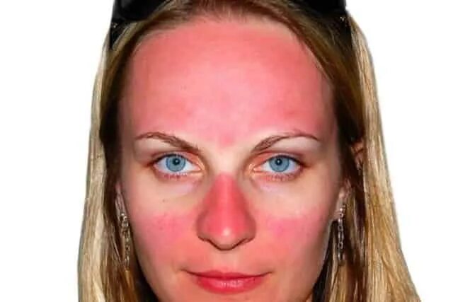 Ожог лица фото White Spots on Face, Dots, Patches, Small, Pictures, Causes, Get Rid, Treatment 