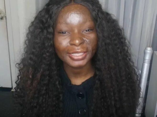 Ожог лица фото This Burn Survivor Is The Most Incredible Makeup Artist You'll Ever See Diário d