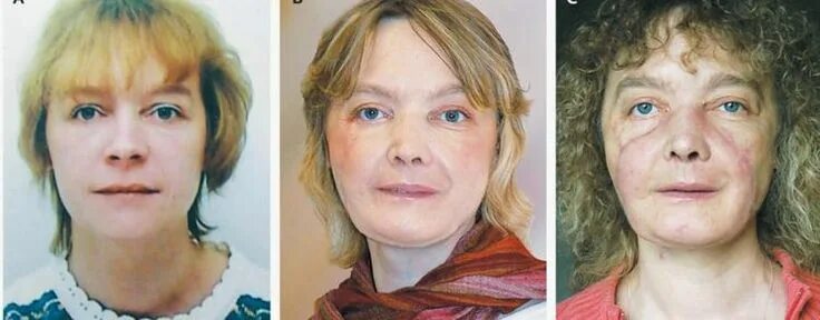 Ожог лица огнем фото до и после The Woman Who Received the World's First Face Transplant