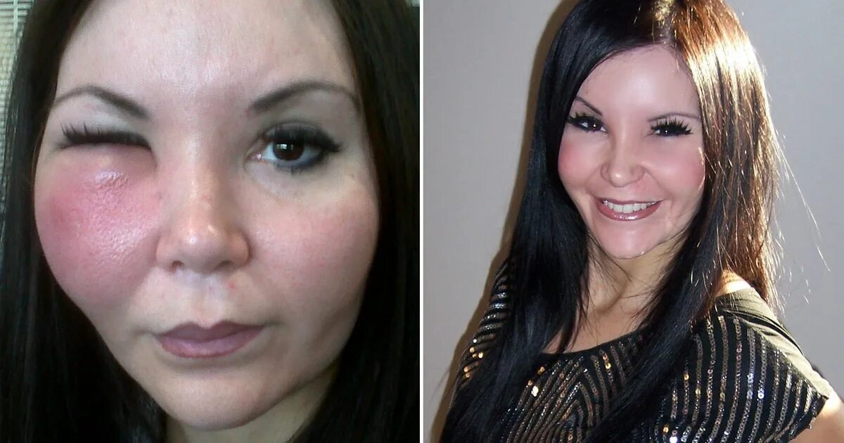 Ожог лица огнем фото до и после I had surgery to look like Martine McCutcheon but 30-minute filler treatment rui