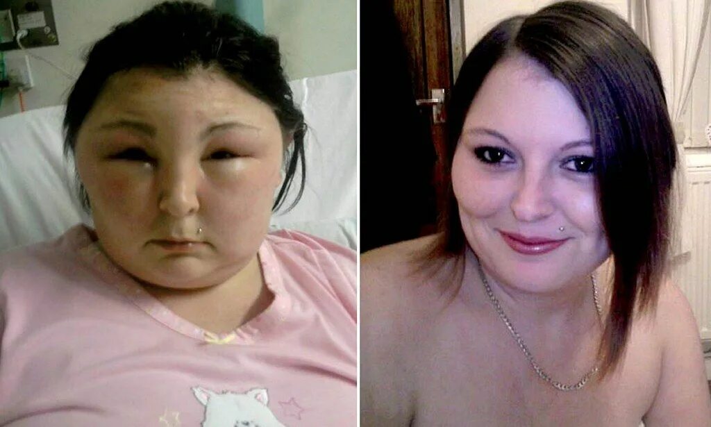 Ожог лица огнем фото до и после My head turned into a football! Shocking pictures show swollen face of woman, 25