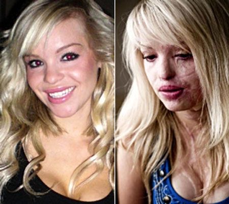 Ожог лица огнем фото до и после Katie Piper -"Believe in yourself'. Reframe your thoughts to look at a situation