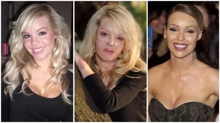 Ожог лица огнем фото до и после Айдай сұлу қыздарды бір сәтте құбыжыққа айналдырған жігіттер кімдер?