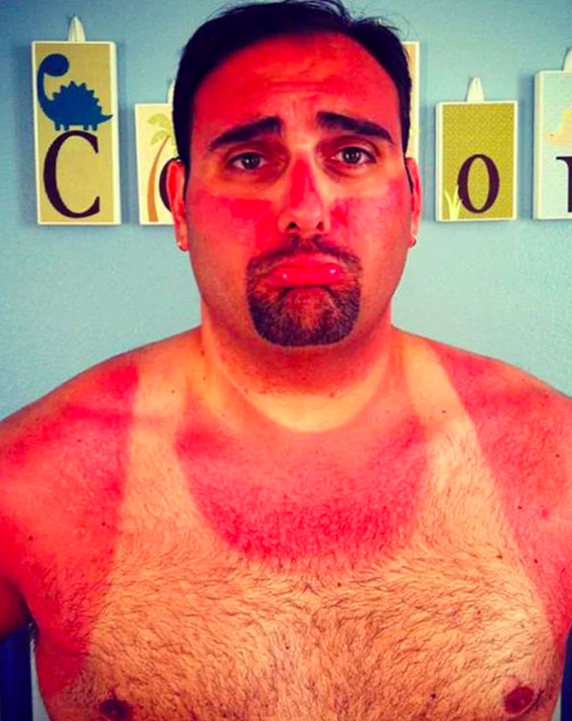 Ожог лица от солнца фото World’s worst sunburn fails are as stupid as they are painful - The Sun The Sun