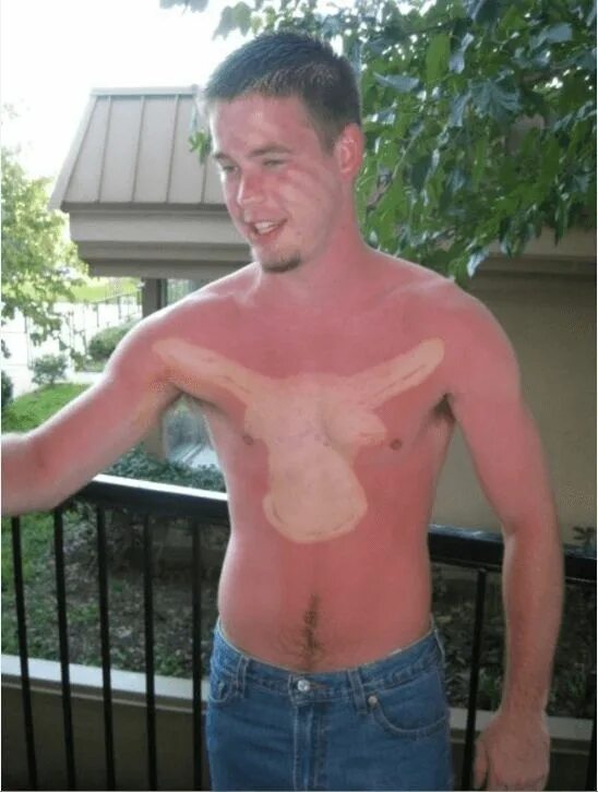 Ожог лица от солнца фото 10 Hilarious Examples Of Sun Tans Gone Very Wrong Bad sunburn, Tan, Pale people