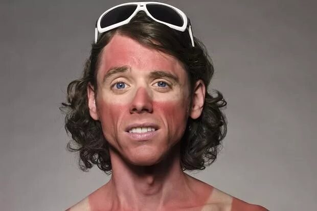 Ожог лица от солнца фото sunburnt face - Google Search Sunburnt face, Get rid of sunburn, Face