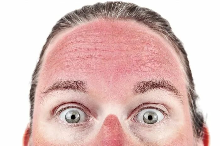 Ожог лица от солнца фото How to Remove Sunburn in Photoshop Sonnenbrand hausmittel, Hilfe bei sonnenbrand