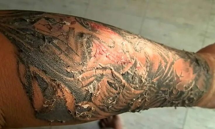 Ожог маслом фото Life Trrends Tattoo healing stages, Healing tattoo, Tattoo healing process