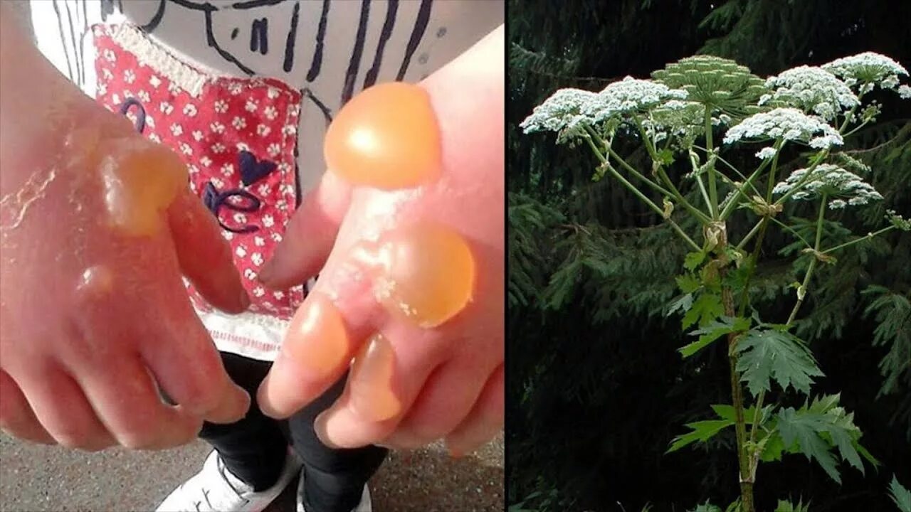 Ожог маслом фото Giant Hogweed - A Flesh-Burning Plant Explained! - YouTube