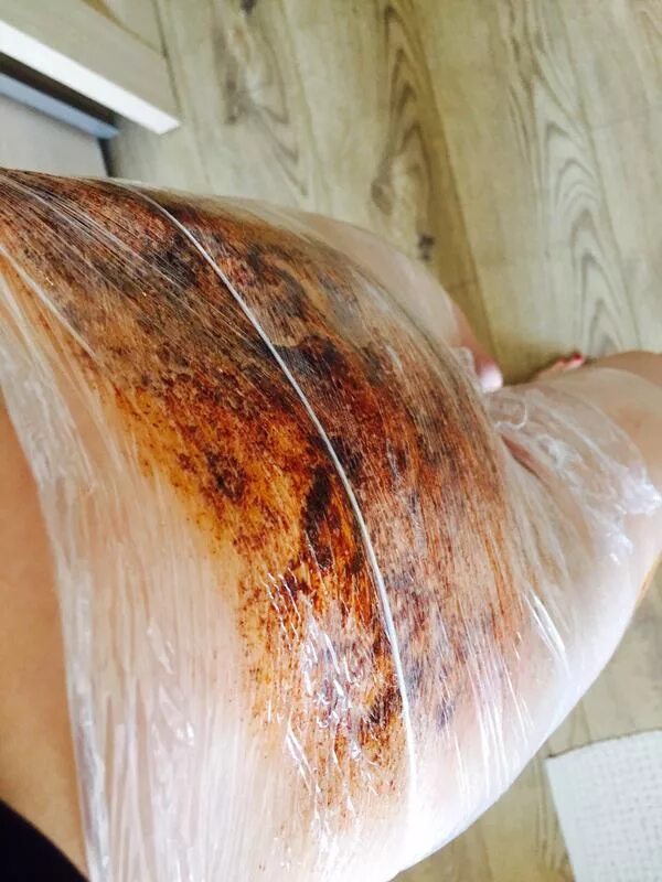 Ожог маслом фото Oil burn