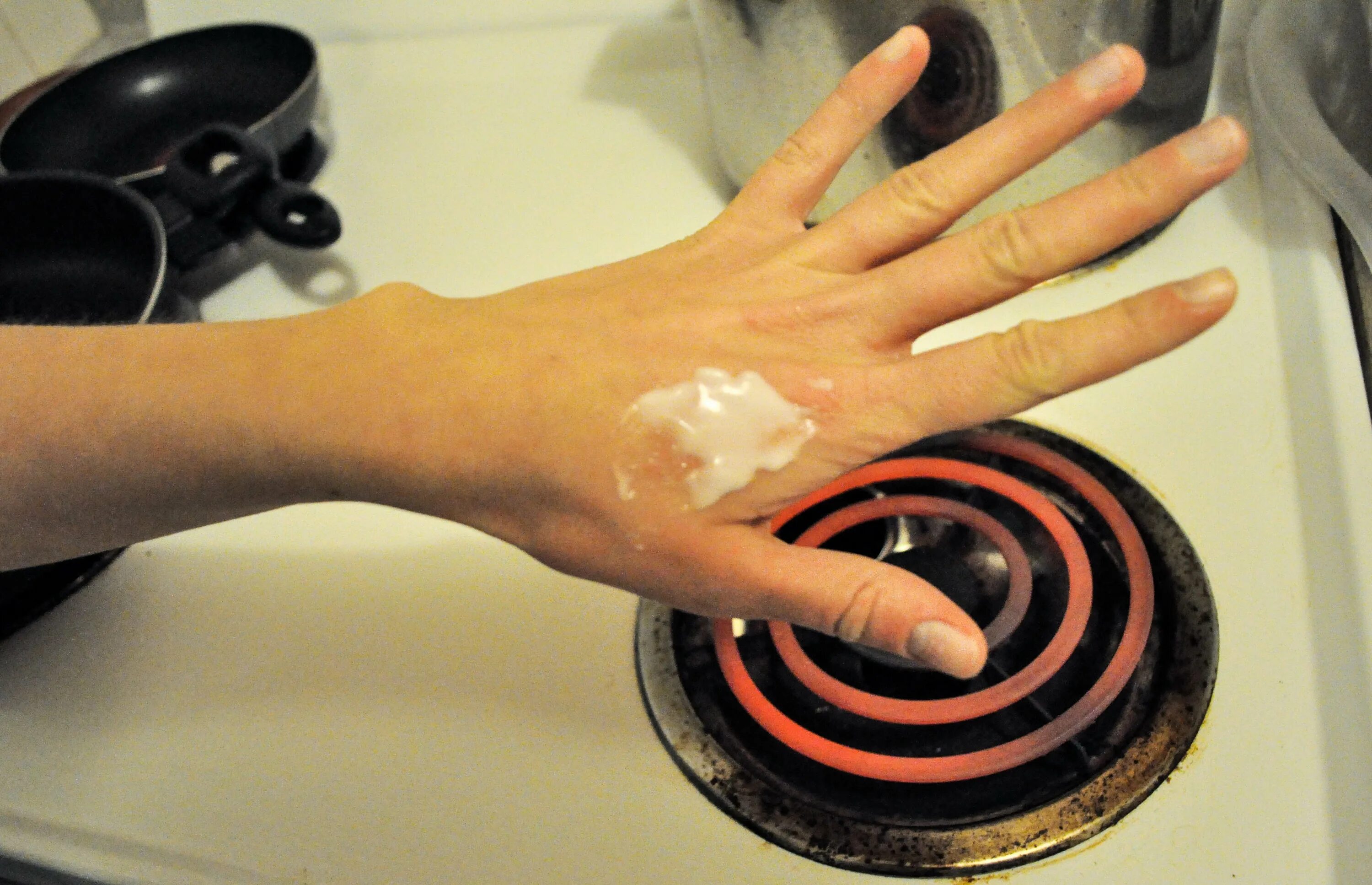 Ожог маслом со сковороды фото When "Caution Hot" Isn't Enough: Burn First Aid