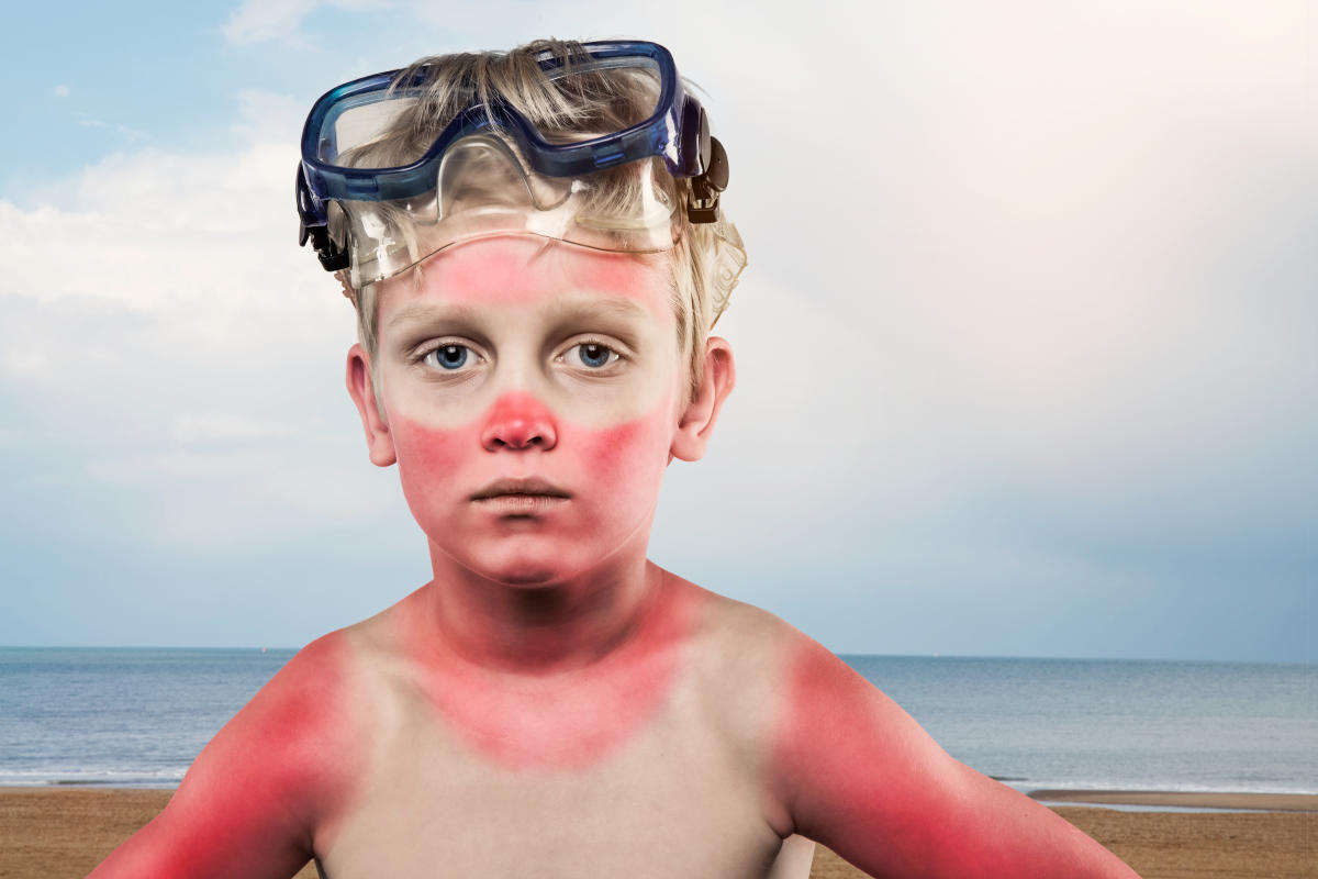 Ожог неба фото I Hate Summer—and You Should Too