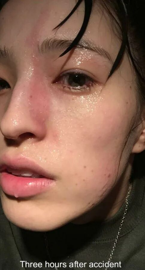 Ожог неба фото Woman reveals horrific facial burns she suffered when vapour from essential oil 