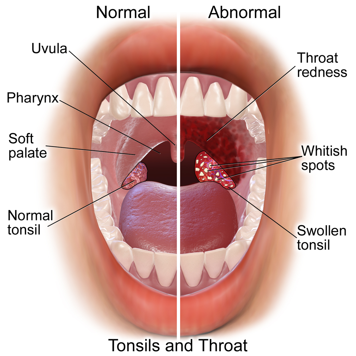 Ожог неба во рту фото File:Blausen 0860 Tonsils&Throat Anatomy.png - Wikipedia