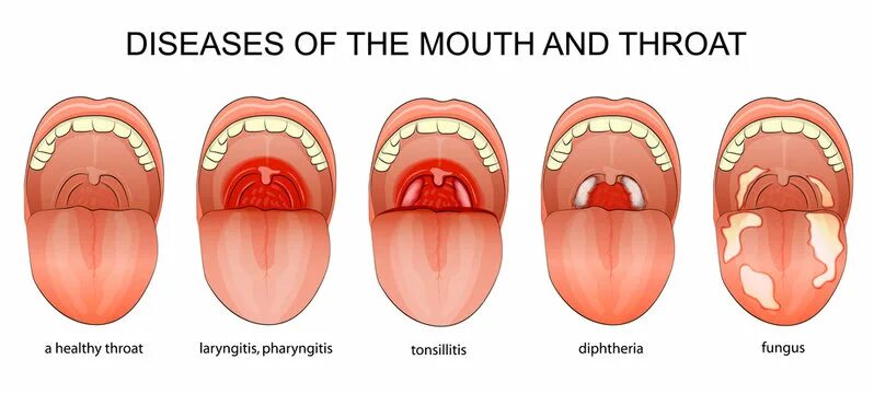 Ожог неба во рту фото у взрослых Strep Throat Зображення - огляд 1,501 Стокові фото, векторні зображення й відео 