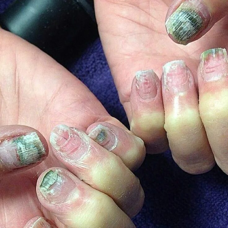 Ожог ногтей от лампы фото This is what can happen if you go to cheap nail bars!! Cheap nail, Bad nails, Na