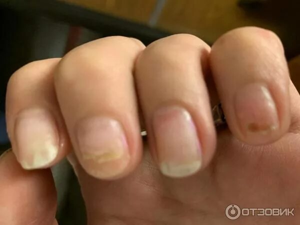 Ожог ногтей от лампы фото Отзыв о Центр красоты Dr.Gar (Россия, Санкт-Петербург) Разочарование