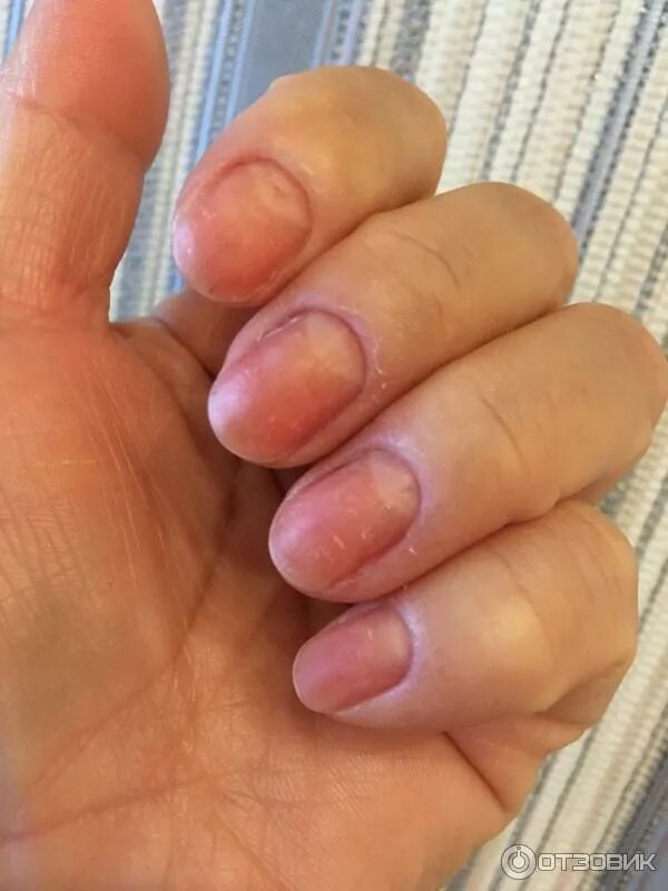 Ожог ногтя фото Отзыв о Жидкость для снятия лака Dr. Nail без ацетона с алоэ такой ужасной жидко