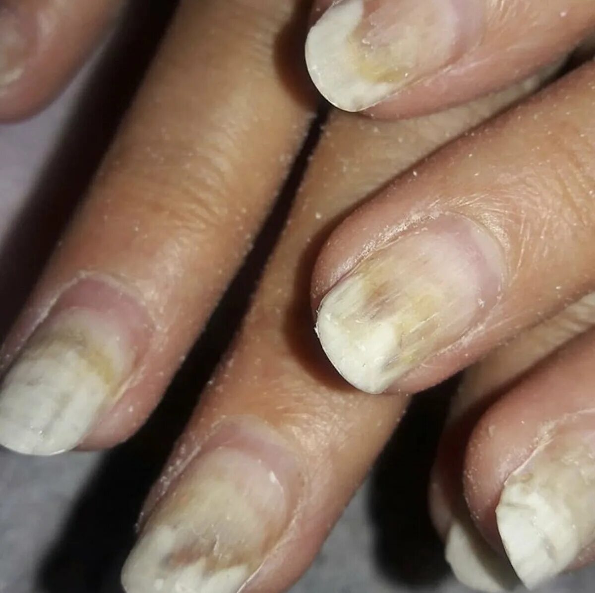 Ожог ногтя при маникюре фото Ужасы маникюра. К чему привела халатность nail-мастера СТИЛИСТ РЕКОМЕНДУЕТ Дзен