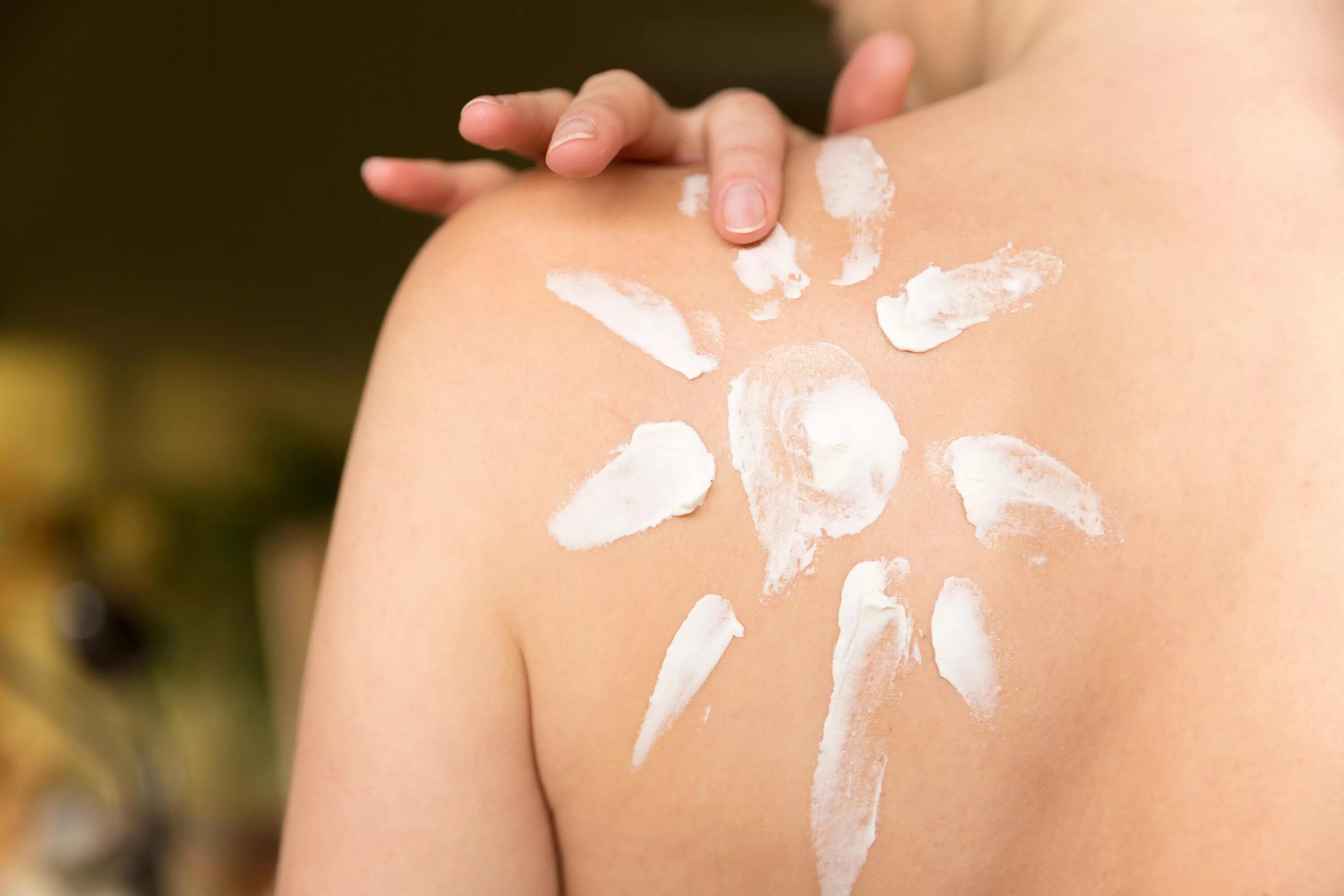 Ожог от крема фото Should sun cream be considered a luxury item in Ireland where 11,000 cases of sk