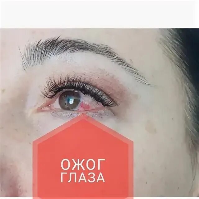 Ожог парами клея при наращивании фото Ретина плюс уфа - найдено 90 картинок