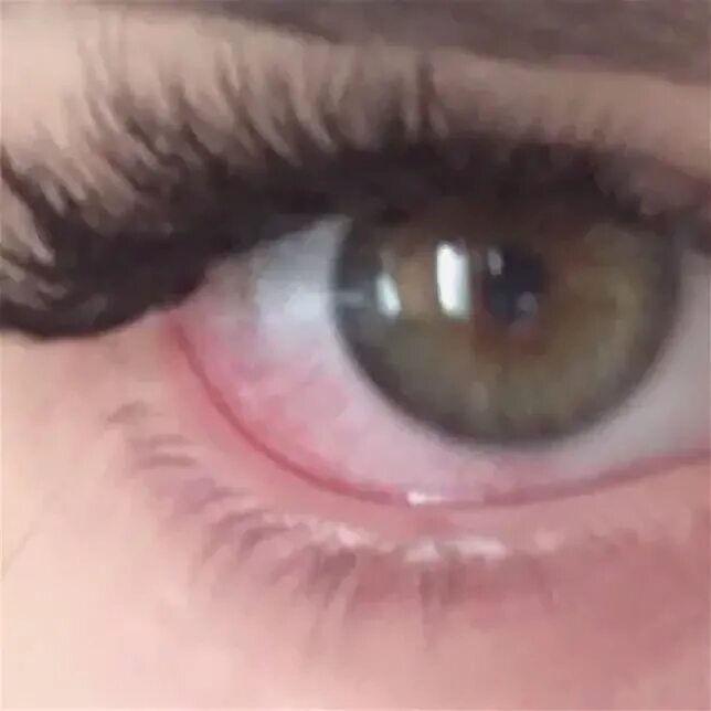 Ожог после наращивания ресниц фото Anonymously. Hello there. Advise eye drops from redness of the eyes, after eyela
