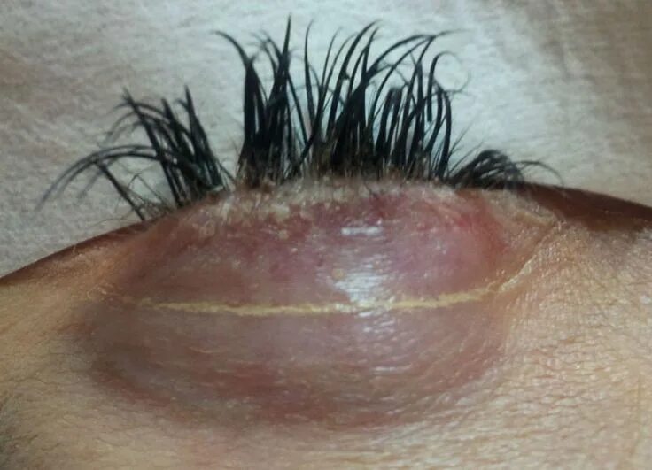 Ожог после наращивания ресниц фото Health Dangers of Using Eyelash Extensions Eyelash extensions care, Eyelash exte
