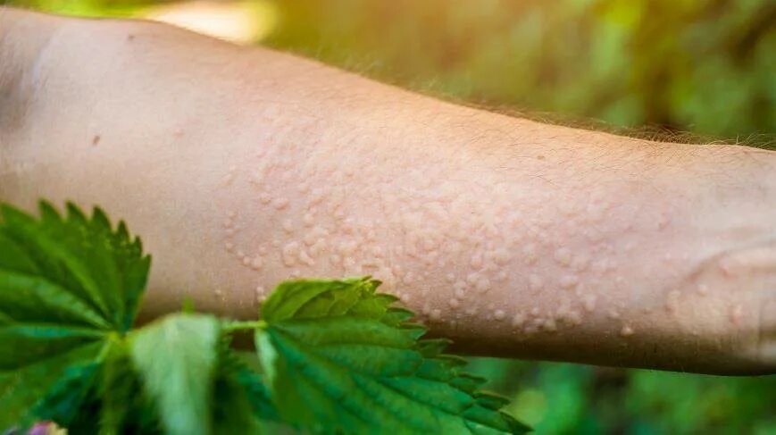 Ожог растением как выглядит Unique beneficial properties of nettle - SIXMD - Vietnamese Online Shop