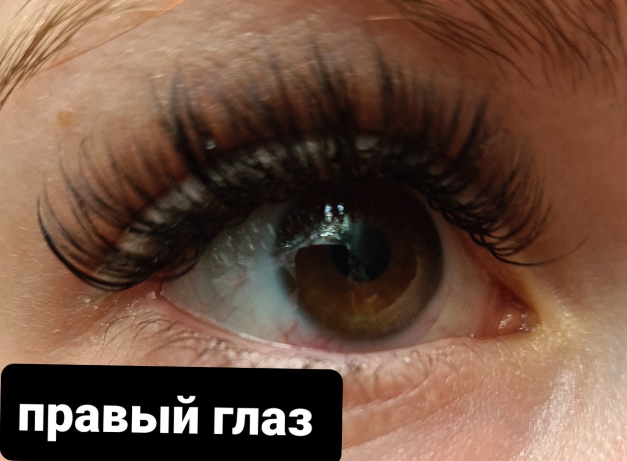 Ожог ресниц фото Сильное покраснение после наращивания ресниц, не спадает, химический ожог рогови