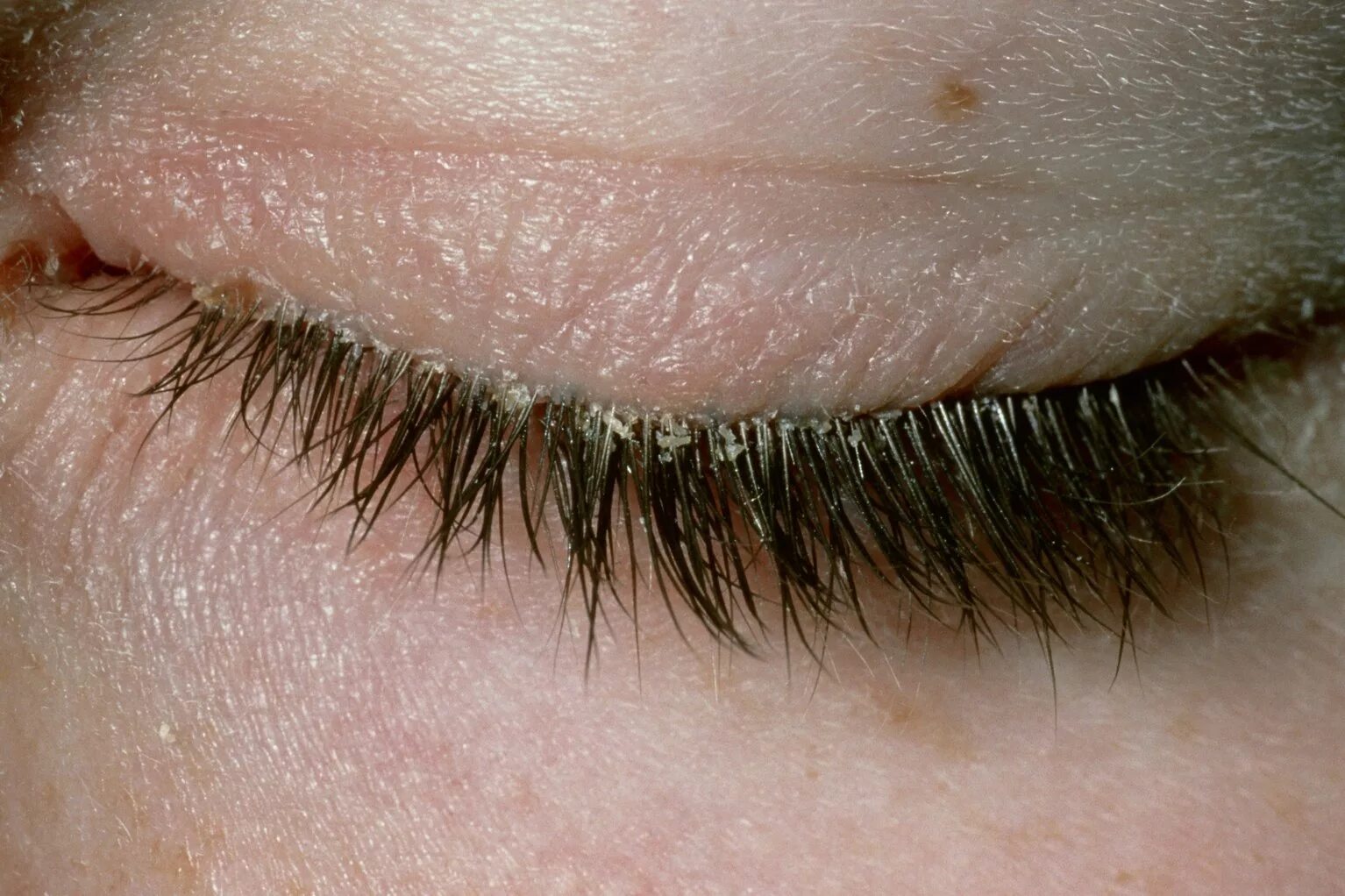 Ожог ресниц фото Blepharitis - NHS