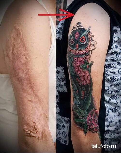 Ожог тату фото Картинки по запросу татуировка на шраме Scars tattoo cover up, Tattoos to cover 