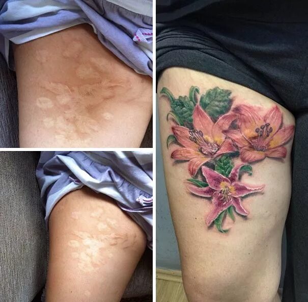 Ожог тату фото 211 Amazing Tattoos That Turn Scars Into Works Of Art Tattoos to cover scars, Co